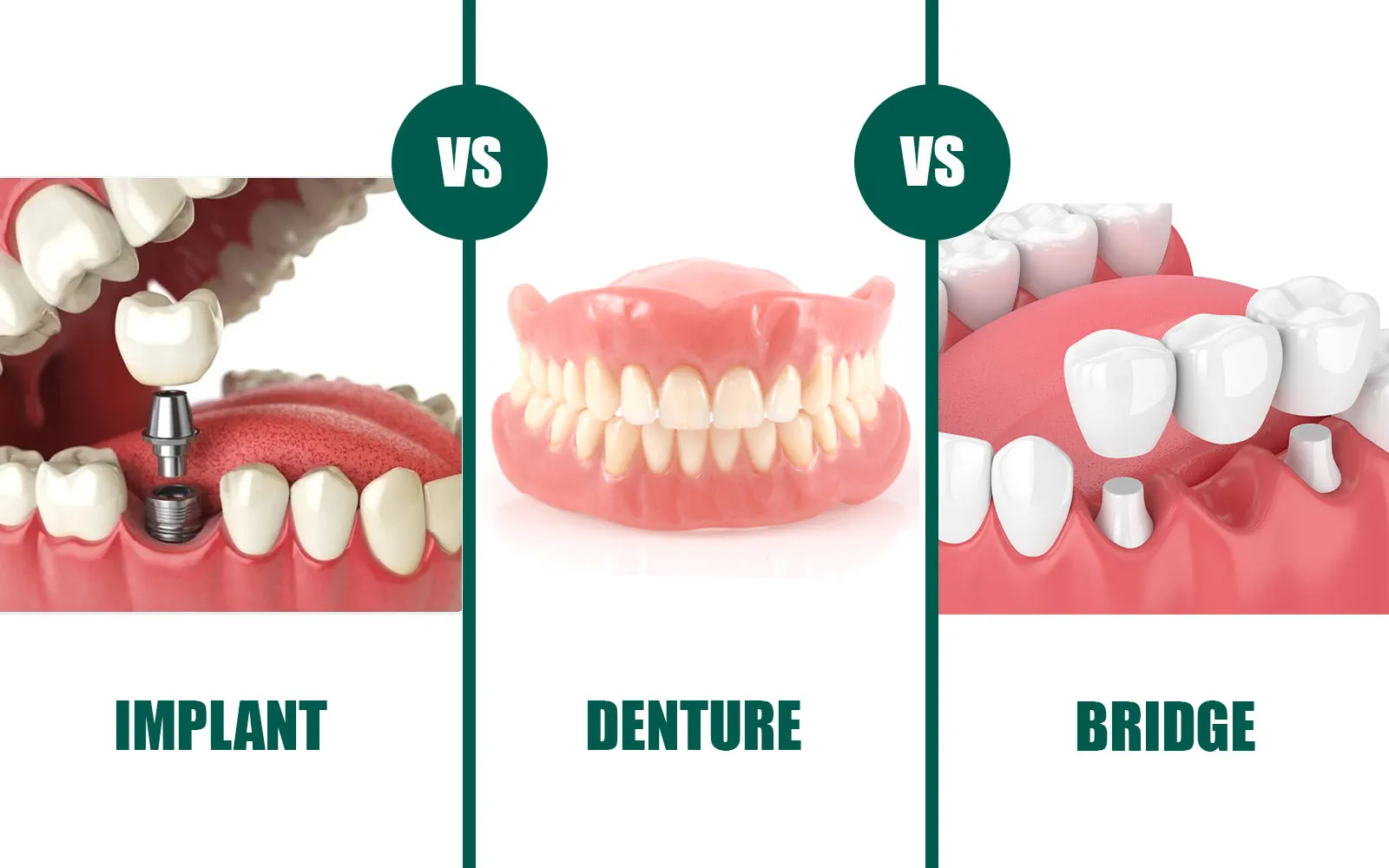 Are dental implants better than dentures or bridges